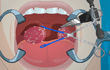 Tonsil Surgery Game